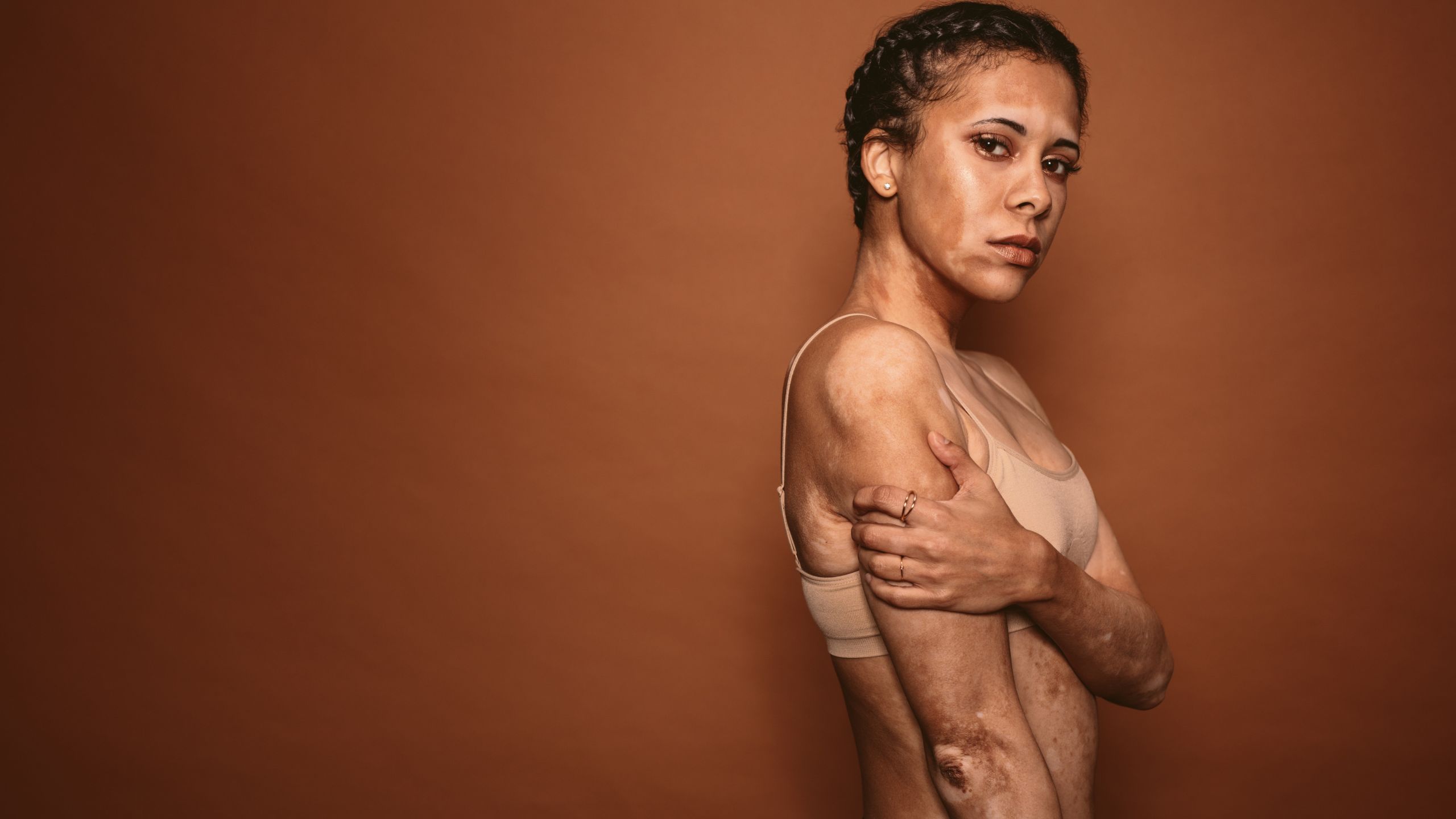 Vitiligo: la piel que también habla